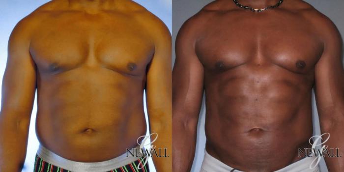Before & After Abdominal Etching For Men Case 17043 View 1 View in Houston, TX