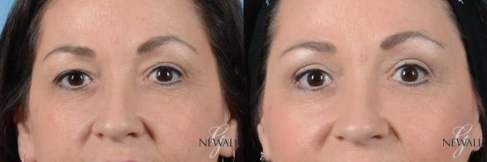 Before & After Blepharoplasty Case 17020 View 1 View in Houston, TX