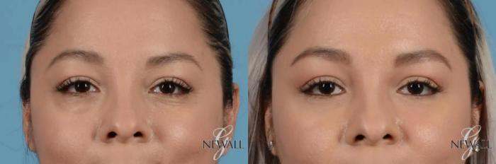 Before & After Blepharoplasty Case 17453 View 1 View in Houston, TX