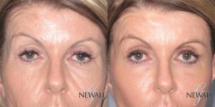 Before & After Blepharoplasty Case 17566 View 1 View in Houston, TX