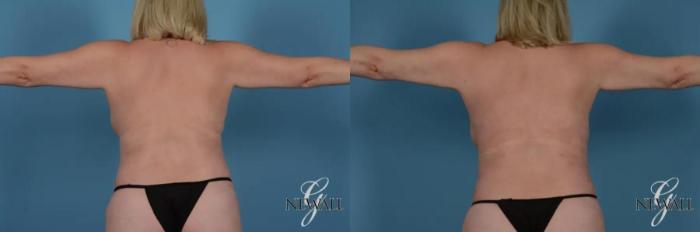 Before & After BodyTite Case 17411 View 1 View in Houston, TX