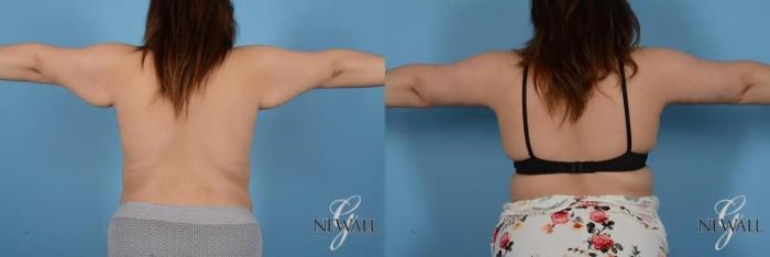 Before & After Brachioplasty Case 17002 View 1 View in Houston, TX