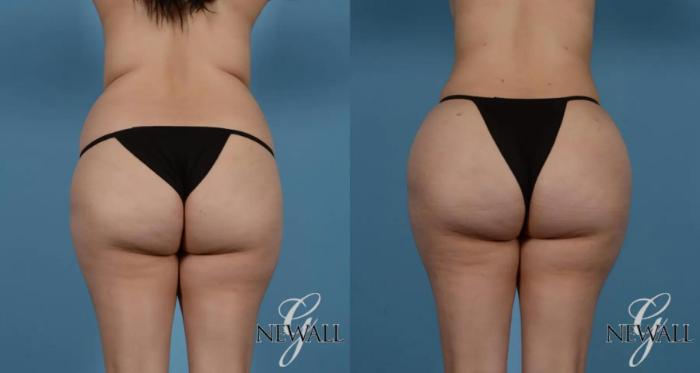 Before & After Brazilian Butt Lift Case 16980 View 1 View in Houston, TX