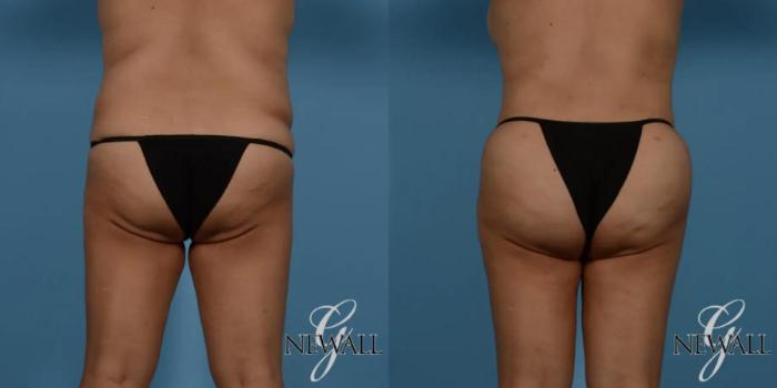 Before & After Brazilian Butt Lift Case 16988 View 1 View in Houston, TX