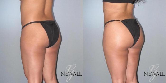 Before & After Brazilian Butt Lift Case 17027 View 1 View in Houston, TX