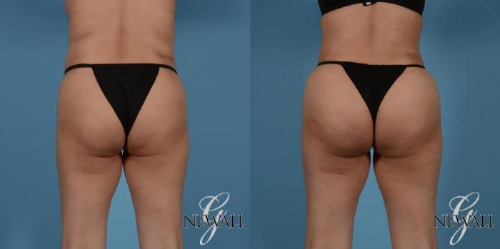 Before & After Brazilian Butt Lift Case 17525 View 1 View in Houston, TX