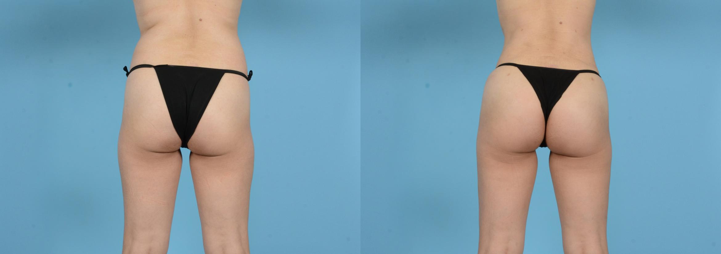 Before & After Brazilian Butt Lift Case 18146 Back View in Houston, TX