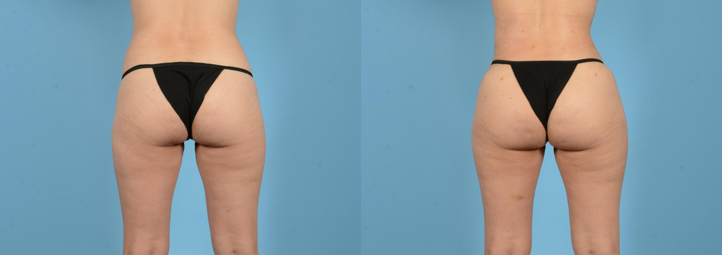 Before & After Brazilian Butt Lift Case 18148 Back View in Houston, TX