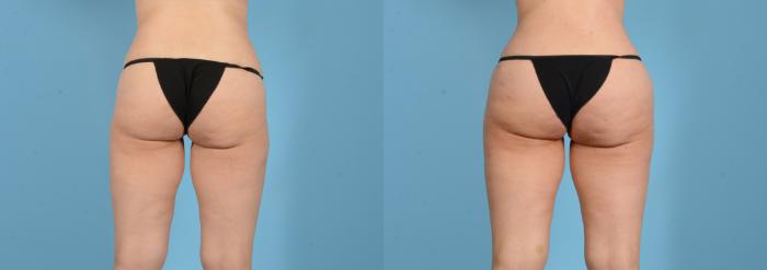 Before & After Brazilian Butt Lift Case 18160 Back View in Houston, TX