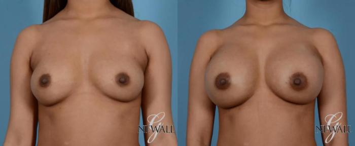 Before & After Breast Augmentation Case 16974 View 1 View in Houston, TX