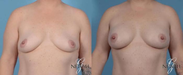 Before & After Breast Augmentation Case 16986 View 1 View in Houston, TX