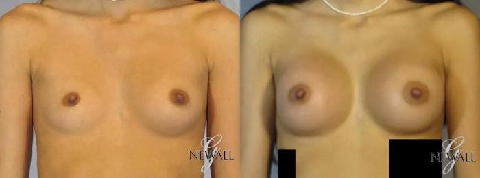 Before & After Breast Augmentation Case 17824 View 1 View in Houston, TX