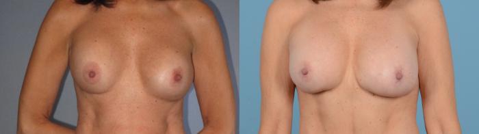 Before & After Breast Augmentation Case 18130 Front View in Houston, TX