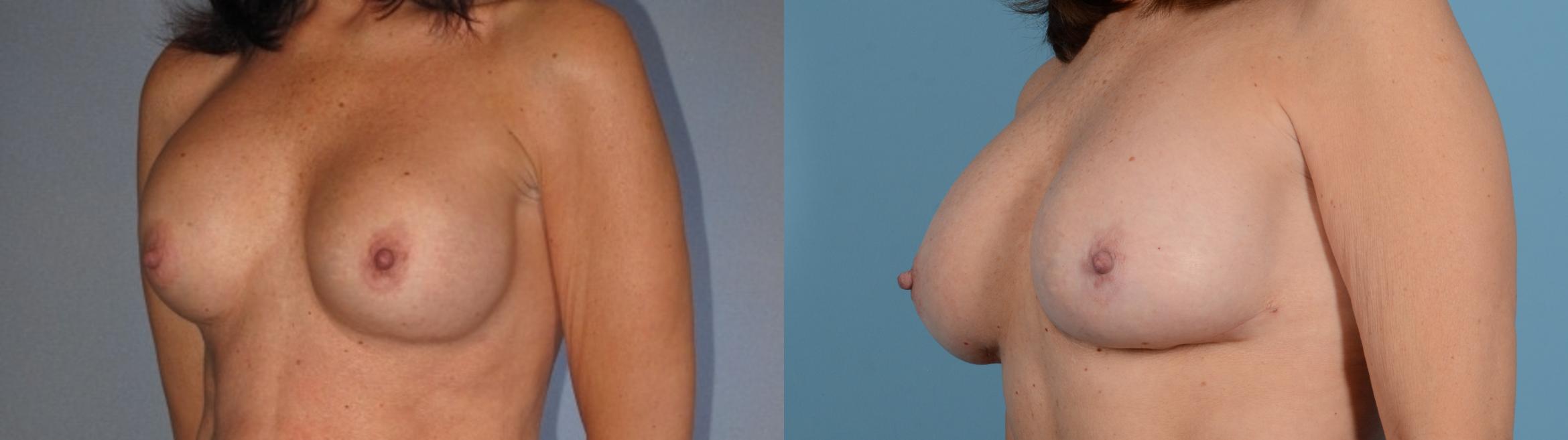 Before & After Breast Augmentation Case 18130 Left Oblique View in Houston, TX