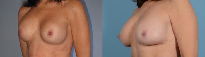 Before & After Breast Augmentation Case 18130 Left Oblique View in Houston, TX
