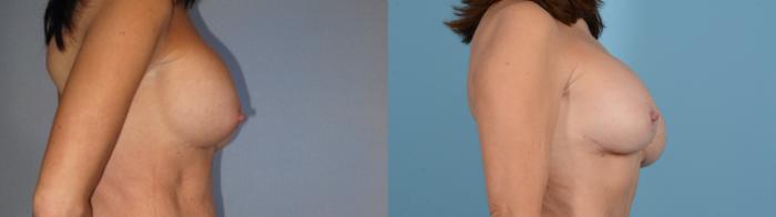 Before & After Breast Augmentation Case 18130 Left Side View in Houston, TX