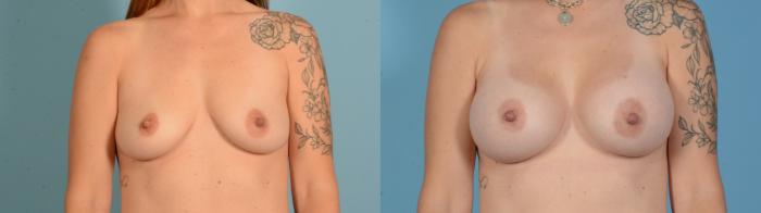 Before & After Breast Augmentation Case 18136 Front View in Houston, TX