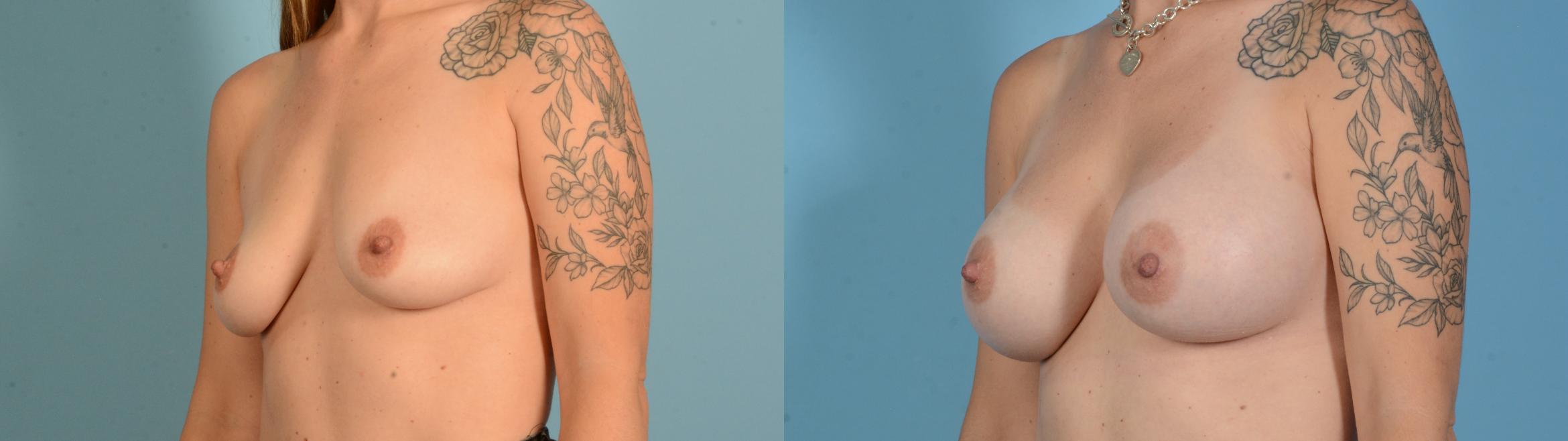 Before & After Breast Augmentation Case 18136 Left Oblique View in Houston, TX