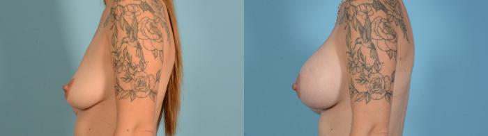 Before & After Breast Augmentation Case 18136 Left Side View in Houston, TX