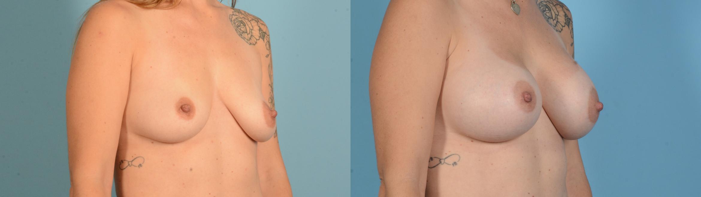 Before & After Breast Augmentation Case 18136 Right Oblique View in Houston, TX