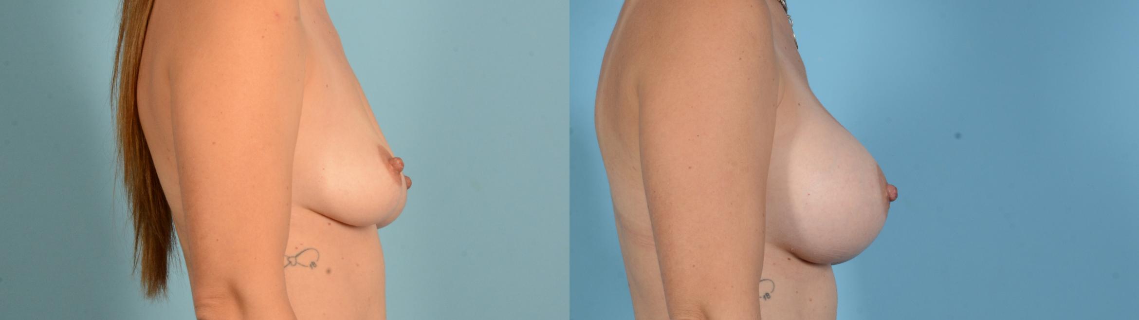 Before & After Breast Augmentation Case 18136 Right Side View in Houston, TX