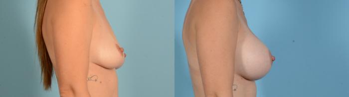 Before & After Breast Augmentation Case 18136 Right Side View in Houston, TX