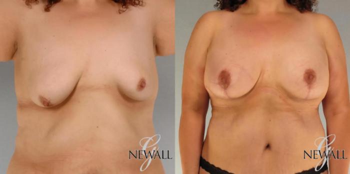 Before & After Breast Augmentation with Lift Case 17823 View 1 View in Houston, TX