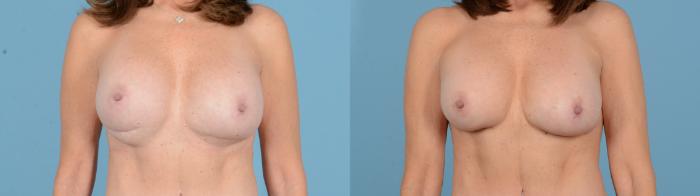 Before & After Breast Implant Exchange Case 18130 Front View in Houston, TX