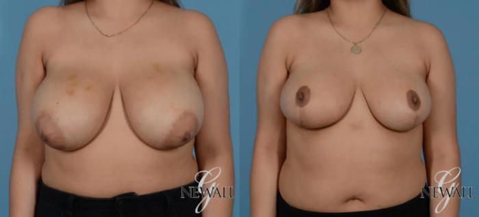 Before & After Breast Lift Case 16991 View 1 View in Houston, TX