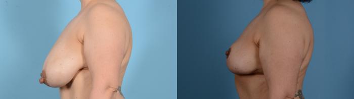 Before & After Breast Lift Case 18131 Left Side View in Houston, TX