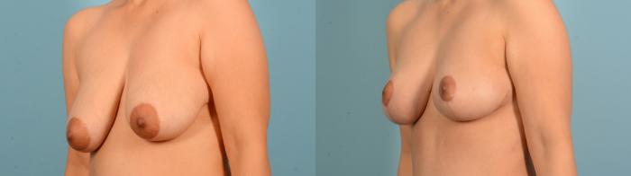 Before & After Liposuction Case 18133 Left Oblique View in Houston, TX