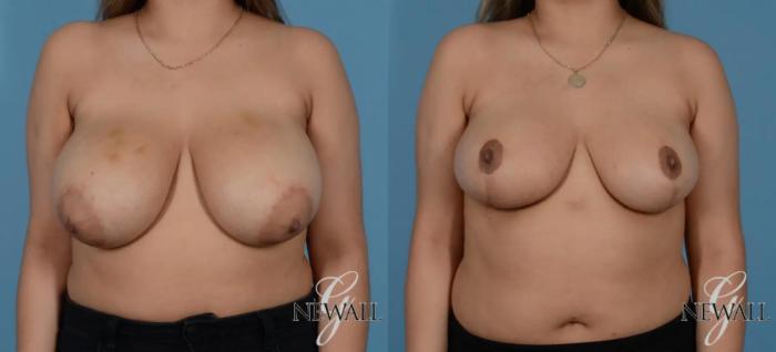 Before & After Breast Reduction Case 16990 View 1 View in Houston, TX