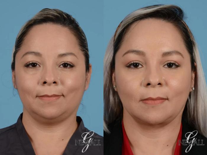 Before & After Buccal Fat Removal Case 17452 View 1 View in Houston, TX