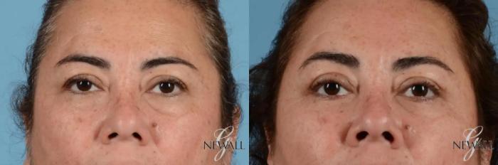 Before & After Eyelid Lift Case 17455 View 1 View in Houston, TX
