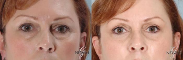 Before & After Eyelid Lift Case 17456 View 1 View in Houston, TX