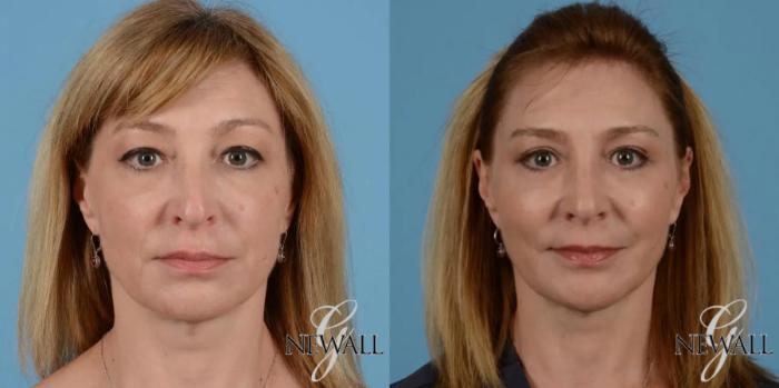 Before & After Eyelid Lift Case 17547 View 1 View in Houston, TX