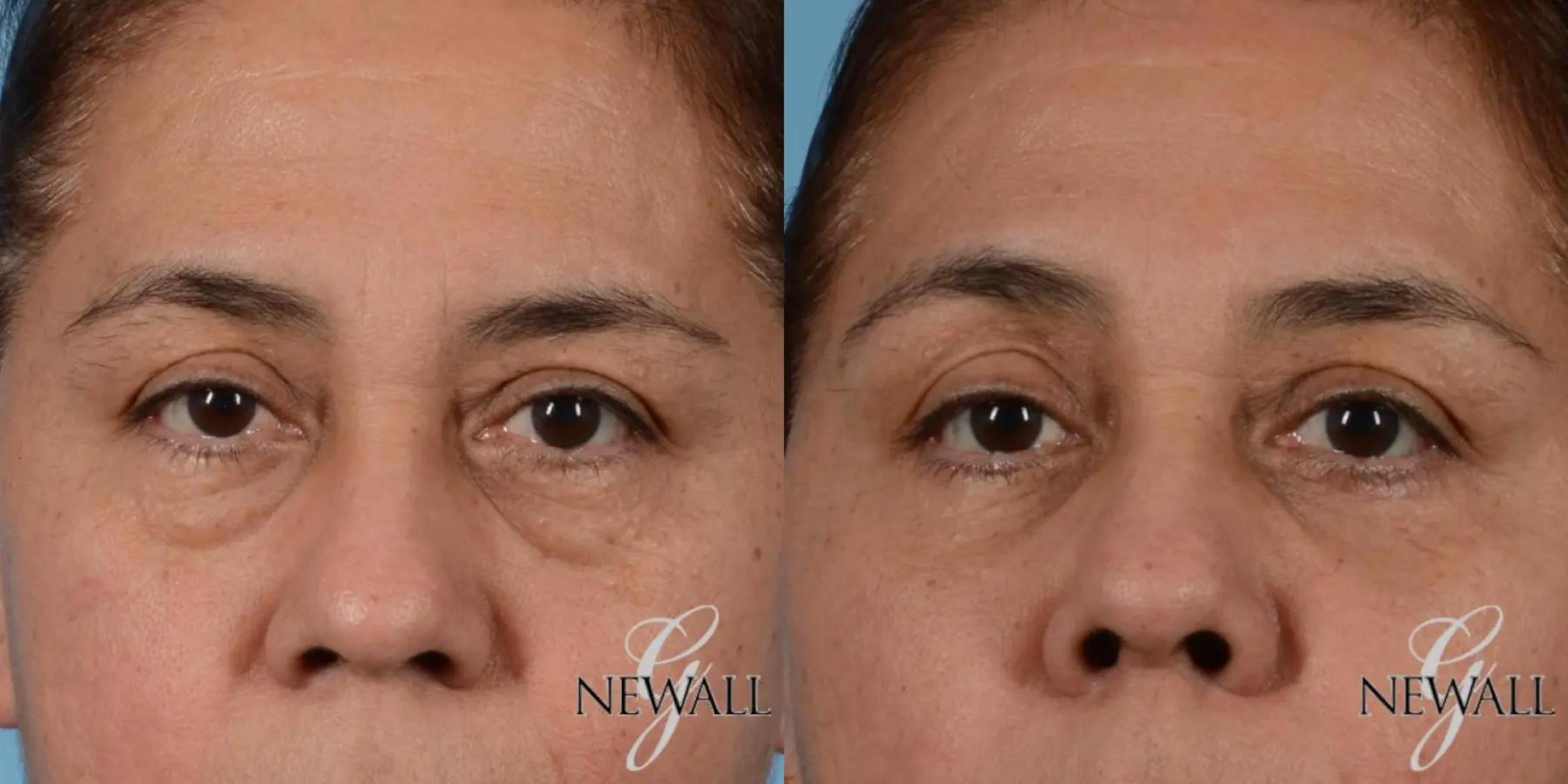 Before & After Eyelid Lift Case 17563 View 1 View in Houston, TX