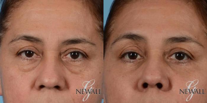 Before & After Eyelid Lift Case 17563 View 1 View in Houston, TX
