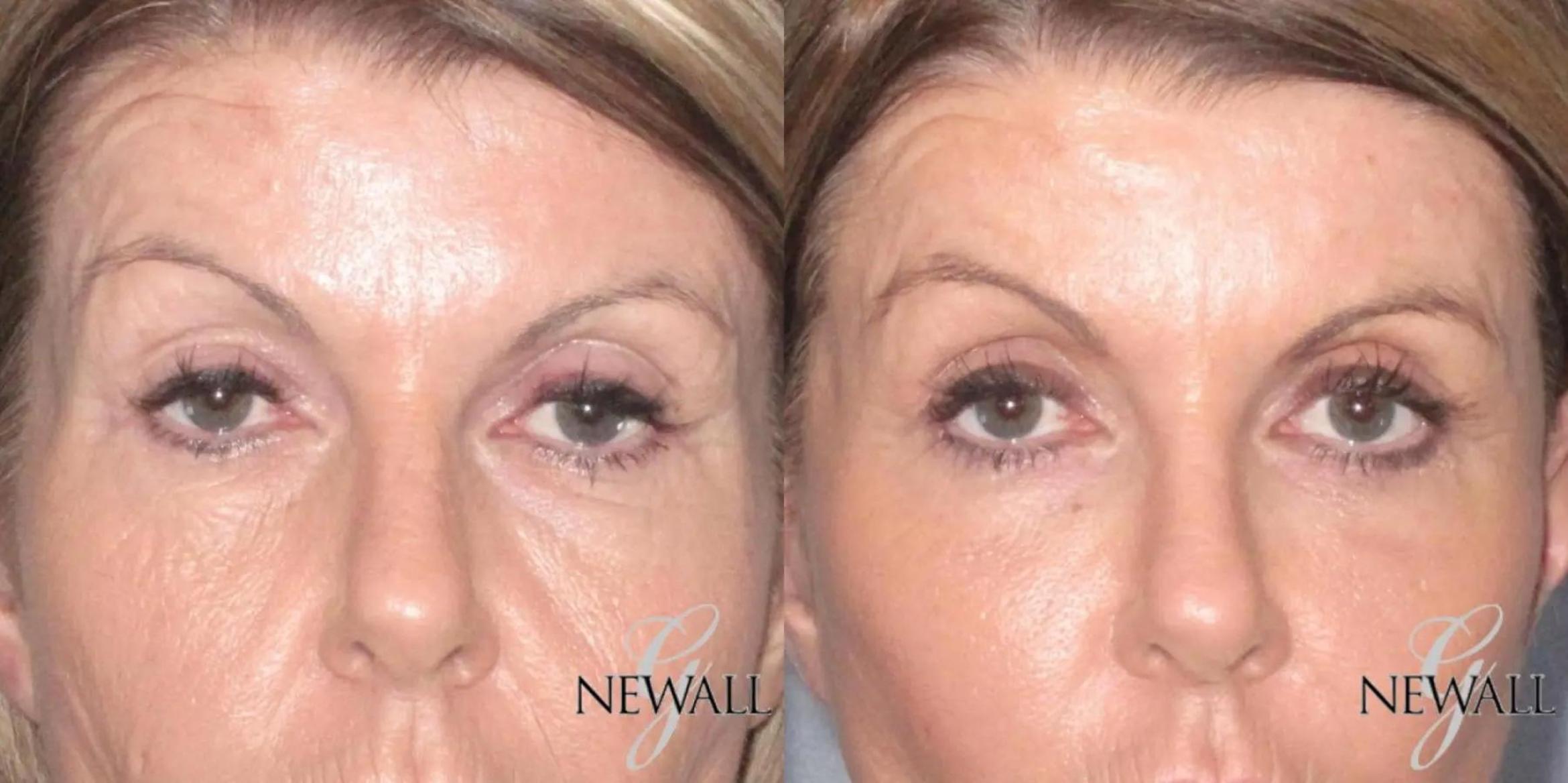 Before & After Eyelid Lift Case 17566 View 1 View in Houston, TX