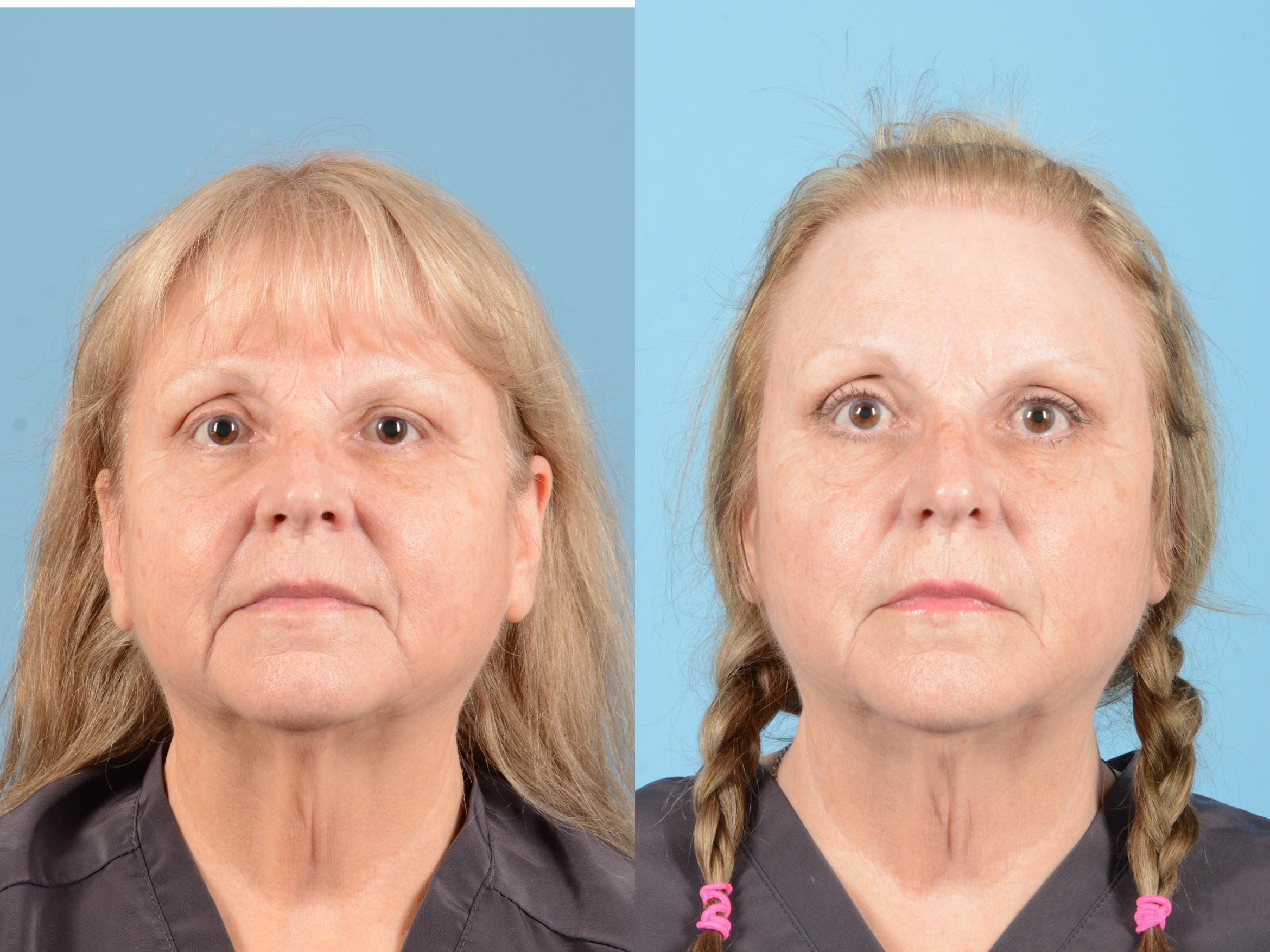 Before & After Eyelid Lift Case 18157 Front 1 View in Houston, TX