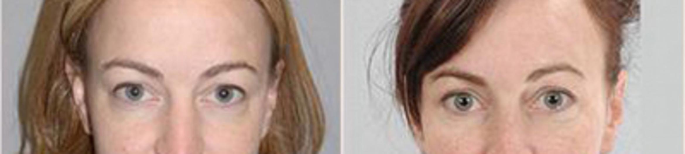 Before & After Eyelid Lift Case 217 View 1 View in Houston, TX