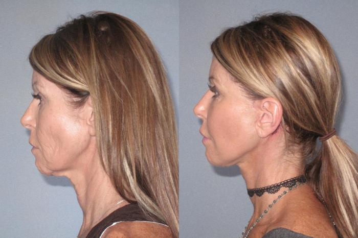 Before & After Neck Lift Case 18125 Left Side View in Houston, TX