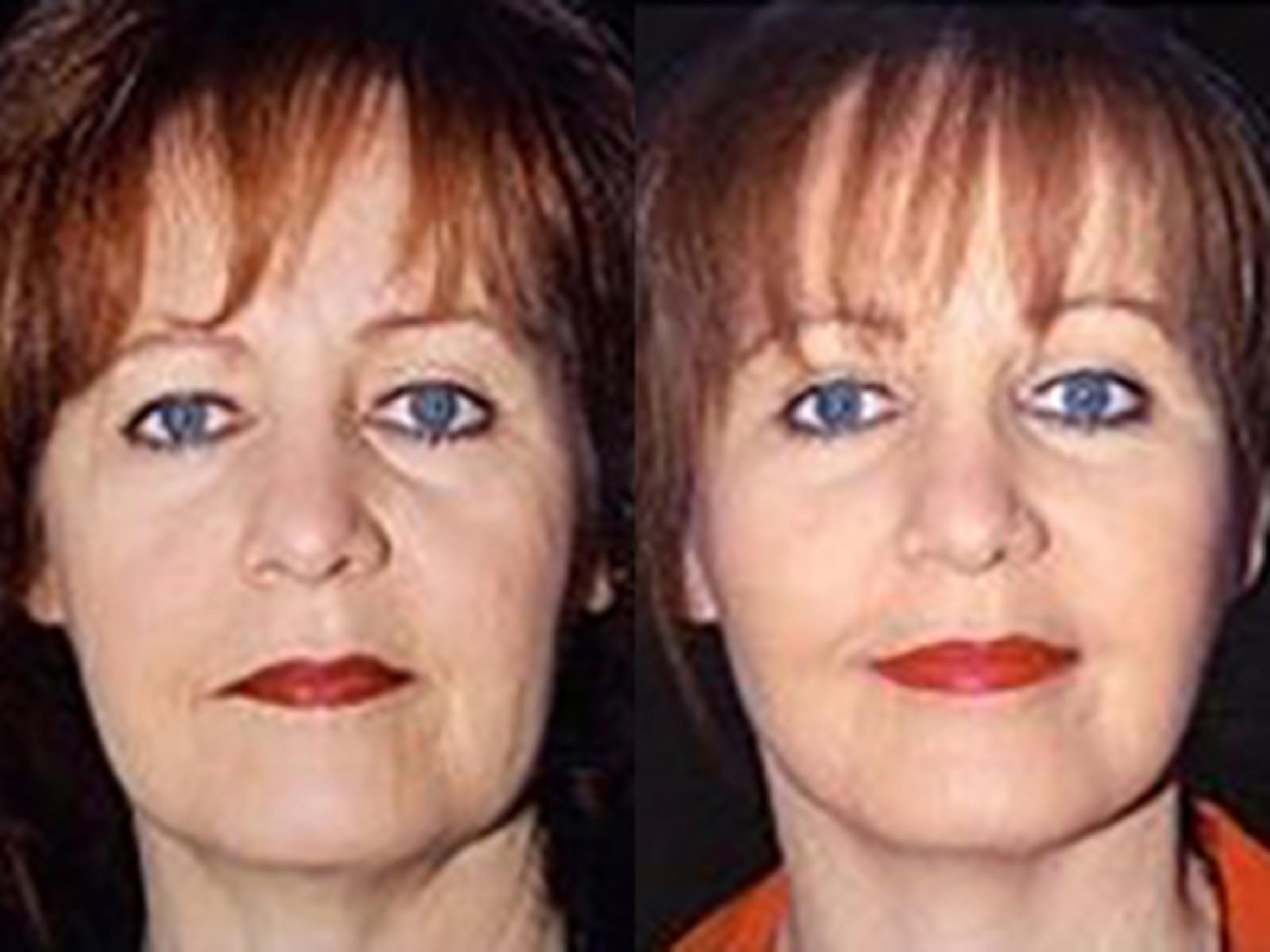Before & After Facelift Case 5735 View 1 View in Houston, TX