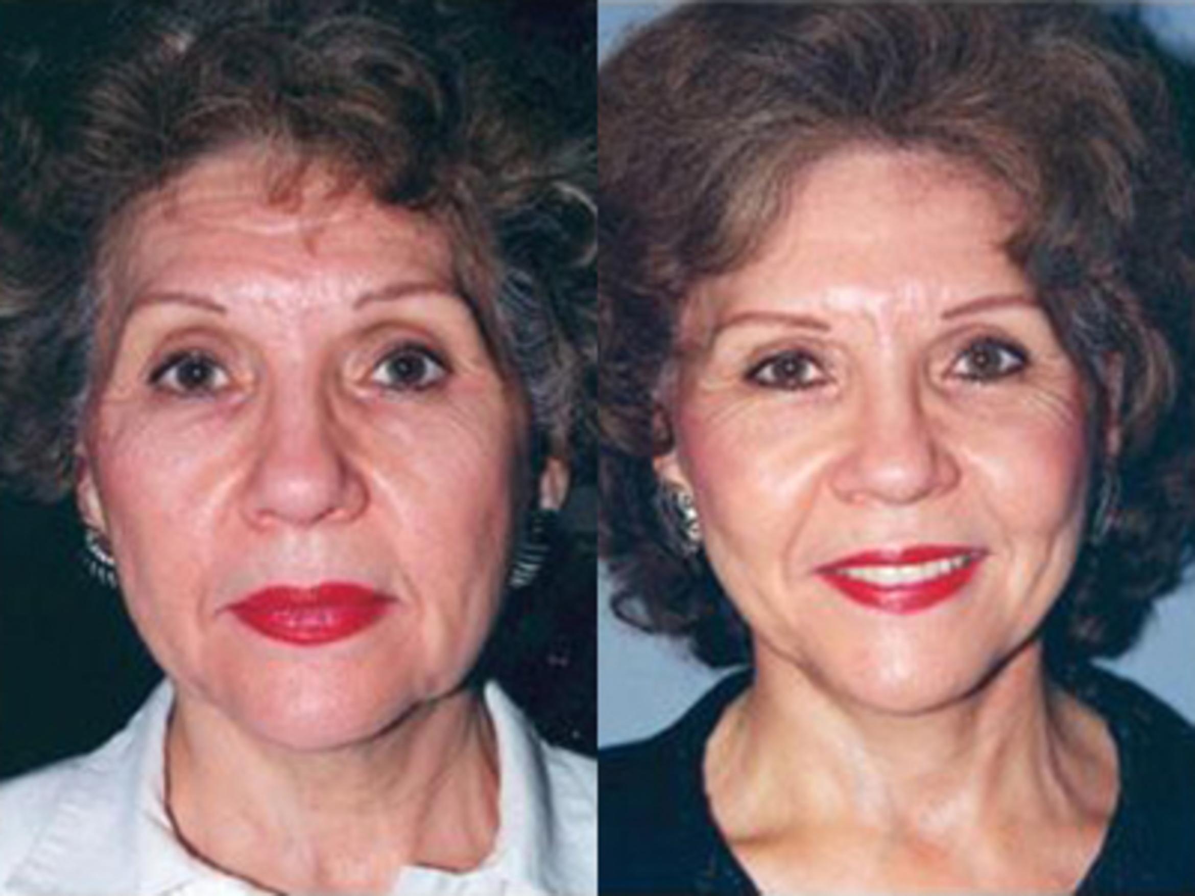 Before & After Facelift Case 5741 View 1 View in Houston, TX