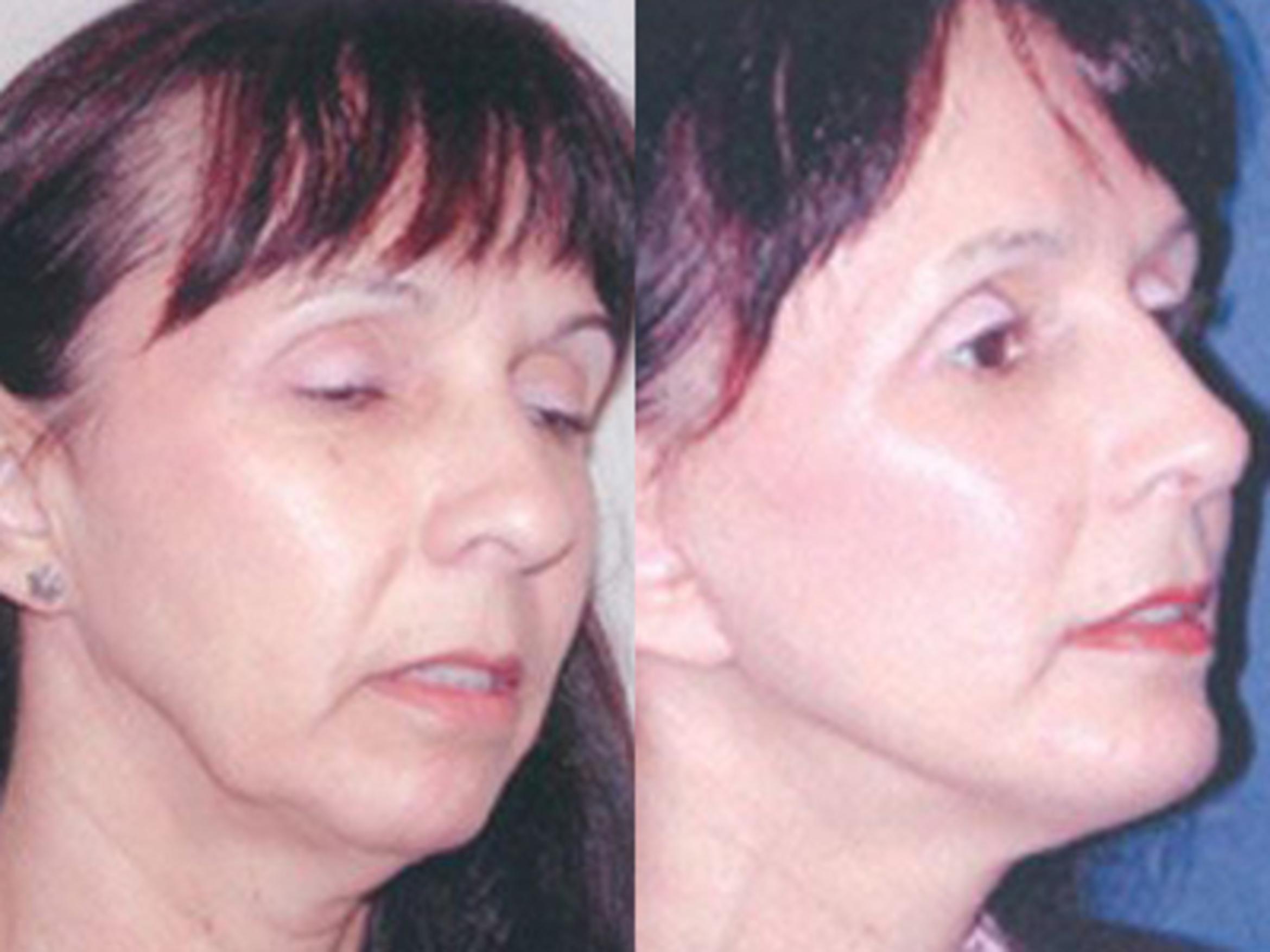 Before & After Facelift Case 5777 View 1 View in Houston, TX