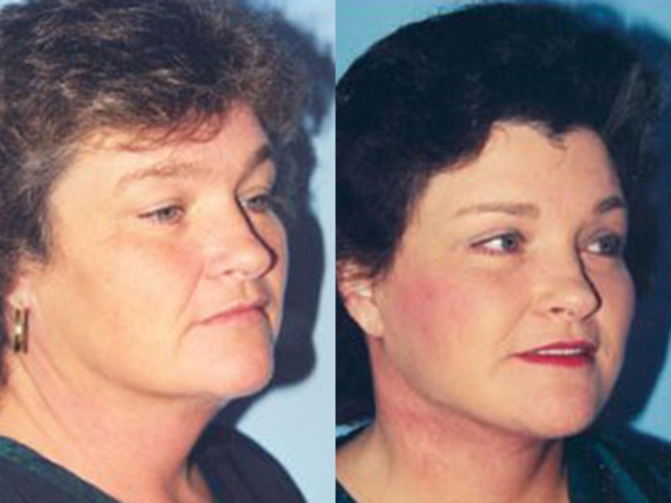 Before & After Facelift Case 5785 View 1 View in Houston, TX