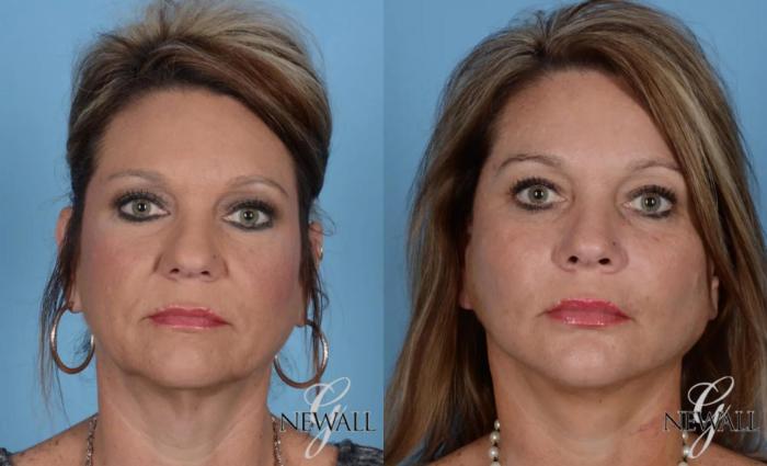 Before & After Facelift & Neck Lift Case 16973 View 1 View in Houston, TX