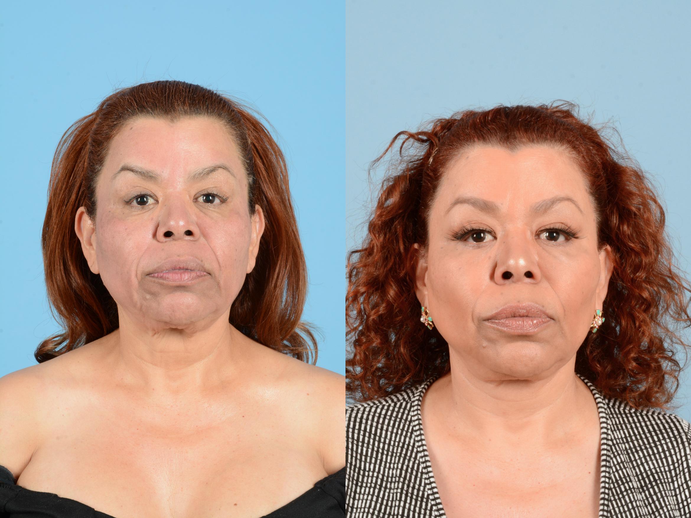 Before & After Facelift & Neck Lift Case 18161 Front 1 View in Houston, TX