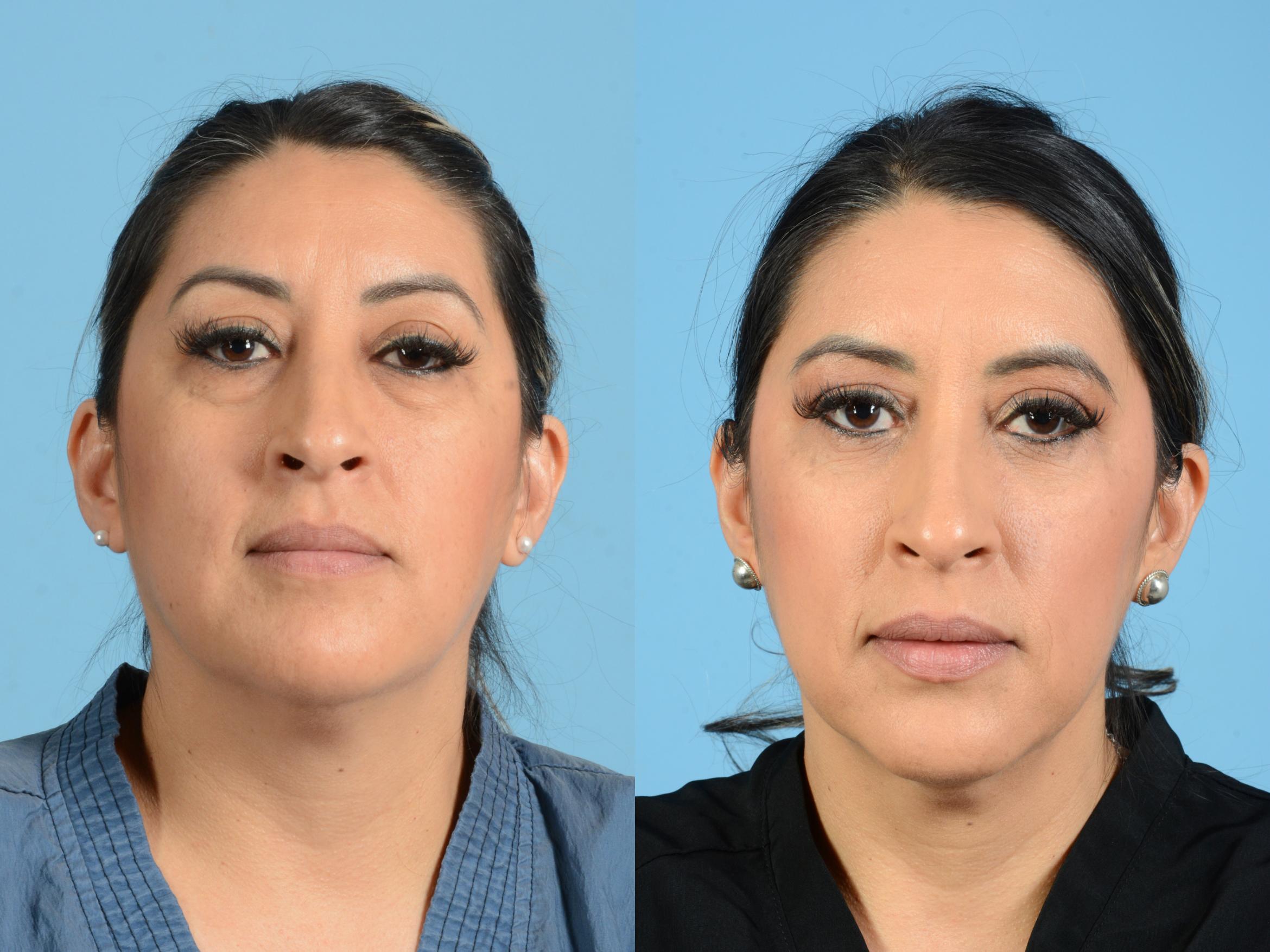Before & After Facial Fat Grafting Case 18166 Front 1 View in Houston, TX