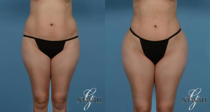 Before & After Liposuction Case 16979 View 1 View in Houston, TX